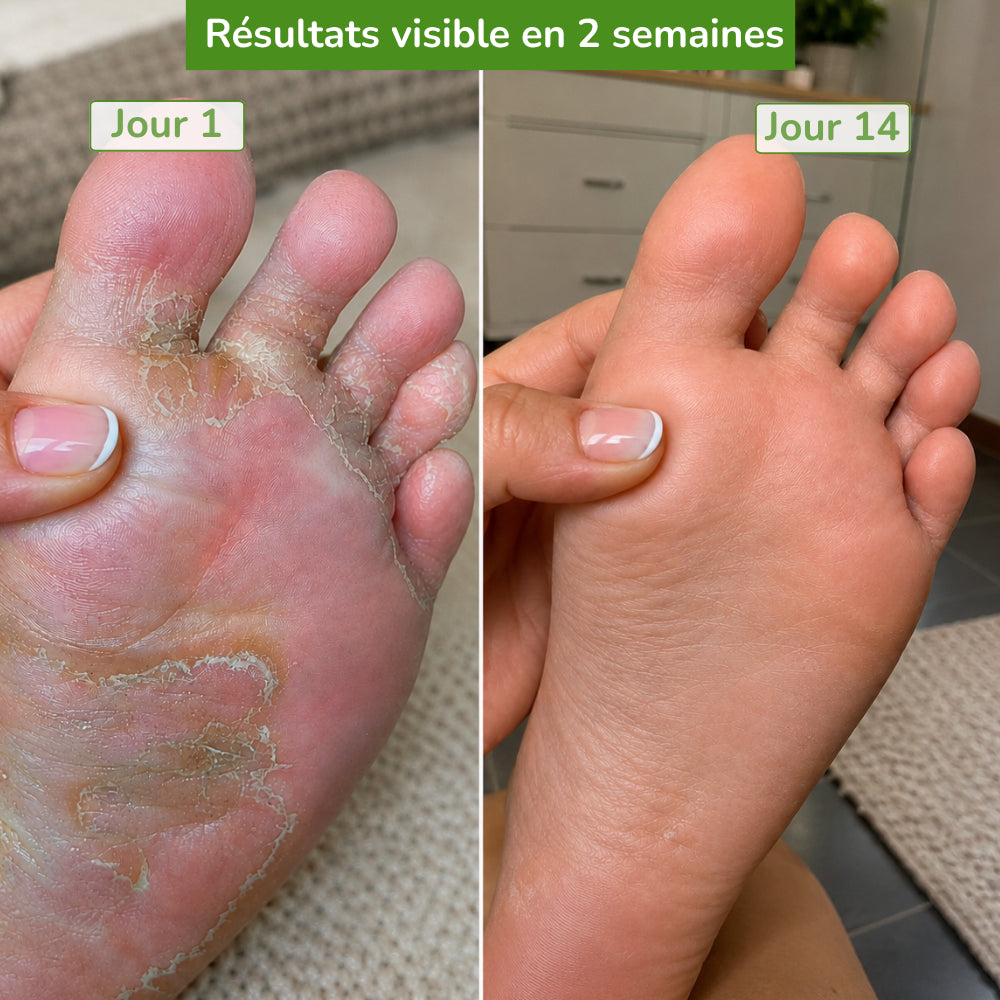 Neutralis — Savon neutralisant mycoses tenaces