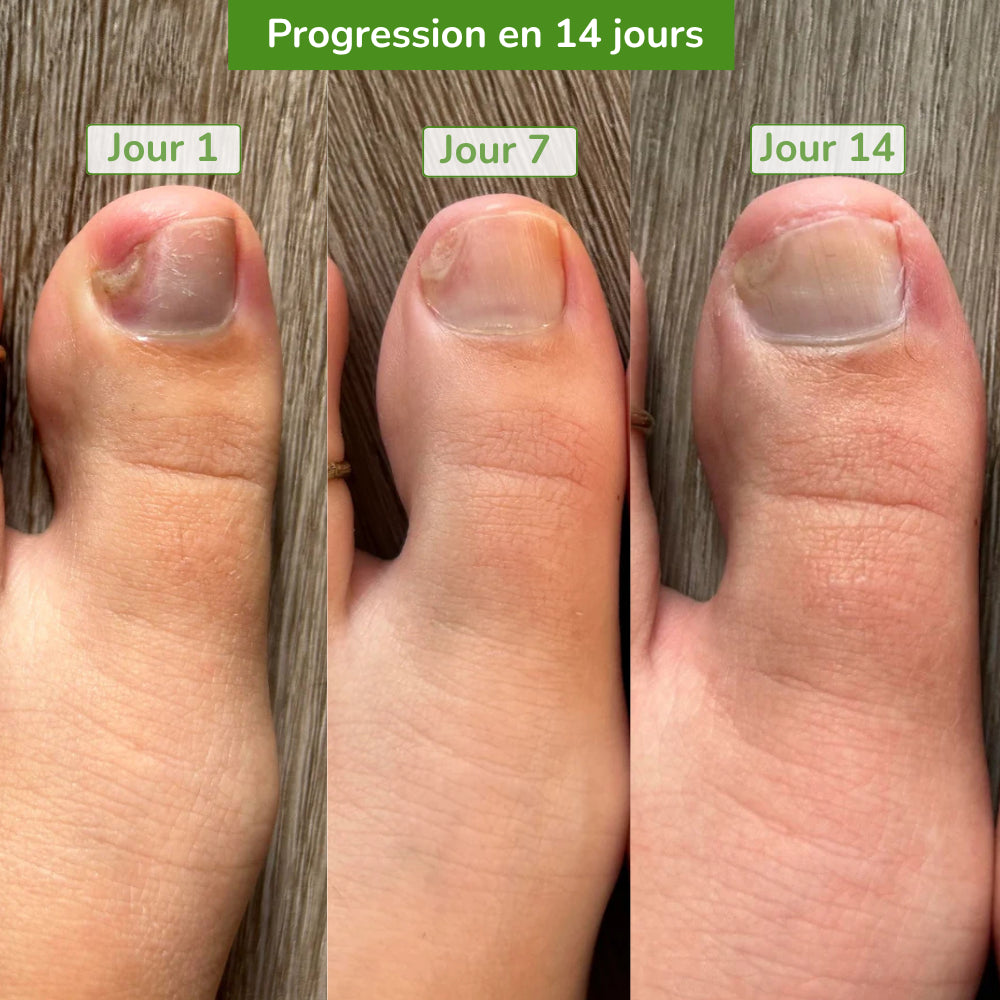 Neutralis — Savon neutralisant mycoses tenaces
